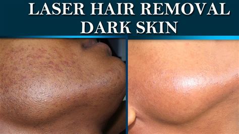 The Role of Aftercare in Maintaining the Results of Magic Laser Hair Removal